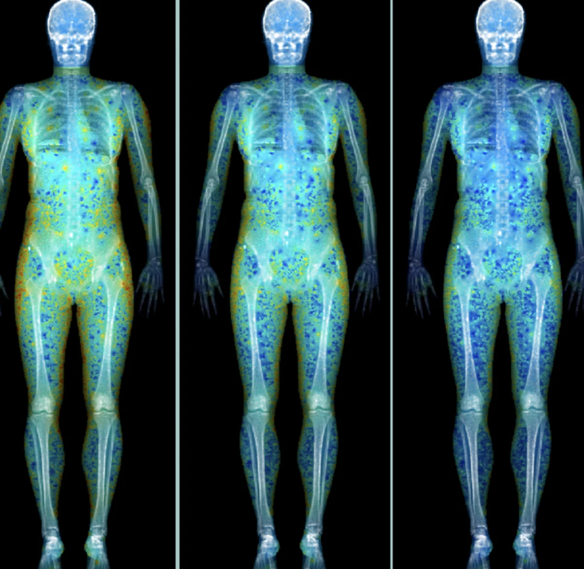 DEXA body composition scan visualization showing muscle and fat distribution